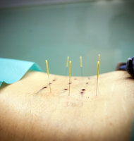 Gordon Welters for The New York Times, Acupuncture may be helpful intreating migraines, arthritis, and chronic pain